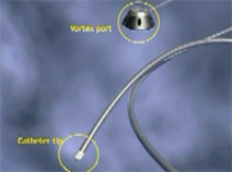 LifePort infusion set
